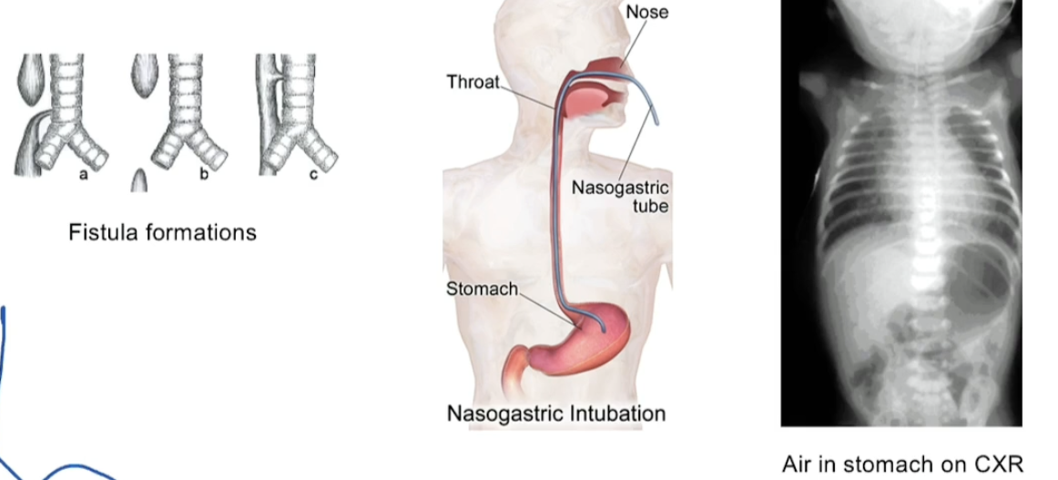 <p>"From embryonic stage (recall lung bud derives from foregut)<br>Sx<br></p><ul><li><p>cant pass NG tube</p></li><li><p>polyhydraminos (bb cant swallow fluid so it builds up)</p></li><li><p>Drooling, vomitting, choking on 1st feed</p></li><li><p>Air in stomach on CXR</p></li></ul><p></p>