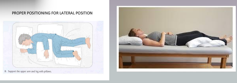 <p>Pressure Injuries</p><p><strong>Prevention</strong></p><ul><li><p>Reposition body every 1-2 hours in bed and every hour when sitting up in a chair</p></li><li><p>Teach patient who are able, to shift weight every 15 minutes</p></li><li><p>Skin care</p></li><li><p>Apply pressure relieving devices including specially designed beds</p></li><li><p>Nurses IRL uses a lot of pillows</p></li></ul><p></p>