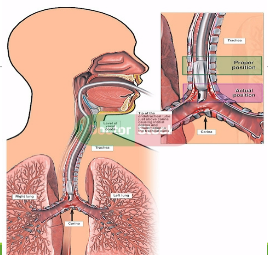 <p><u>indications:</u></p><ul><li><p>compromised airway, resp exacerbations, ABG imbalances, cardiac arrest, low LOC, resp support during &amp; post surgery, life-long use for progressive neuromusc diseases</p></li></ul><p><u>complications:</u></p><ul><li><p>anxiety, delirium, hypotension (due to less room for heart due to big lungs), barotrauma (too much air), ulcer, malnutrition, RF infection, muscle atrophy</p></li></ul><p></p><p><u>nurse role:</u> stabilize airway, gather equipment, inform patient, IV meds, monitoring + assessment, stabilize tube + suction PRN, verify placement, LF gastric distension</p><p><strong><u>confirm placement:</u></strong></p><ul><li><p><strong>LF exhaled CO2 level</strong></p></li><li><p><strong>auscultate bilateral breath sounds</strong></p></li><li><p><strong>symmetry of chest expansion</strong></p></li><li><p><strong>chest x-ray (2-3 cm above carina)</strong></p></li></ul><p><u>goal:</u> short term (2-3 wks), patent airway, low WOB, remove secretions, provide ventilation + O2, prevent complications</p><p></p><p><u>ventilator-associated events (VAE):</u></p><ul><li><p><u>infectious lung injury:</u> ventilator-associated pneumonia (VAP)</p></li><li><p><u>non-infectious lung injury:</u> ventilator-caused injury, atelectasis</p><ul><li><p><strong><u>VAP BUNDLE interventions:</u></strong></p><ul><li><p><strong>HOB 30-45</strong></p></li><li><p><strong>oral care q2-4 hr (6x daily)</strong></p></li><li><p><strong>q12h CHG</strong></p></li><li><p><strong>sedation assessment</strong> (stop sedation daily, readiness to wean)</p></li><li><p><strong>peptic ulcer disease prophylaxis </strong>(pepsid to stop malnourishment issues)</p></li><li><p><strong>DVT prophylaxis</strong> (SCDs, heparin, PT)</p></li><li><p><strong>turn q2</strong></p></li></ul></li></ul></li></ul><p></p>