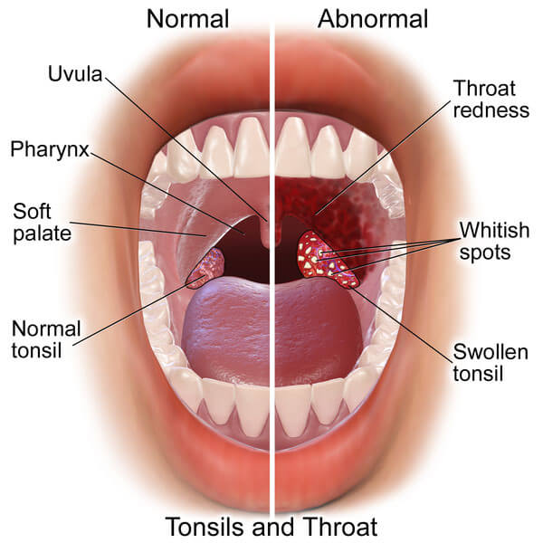 <p>One common symptom of the flu is <strong><em>inflammation of the throat</em></strong>, which can cause soreness and discomfort when swallowing.</p>