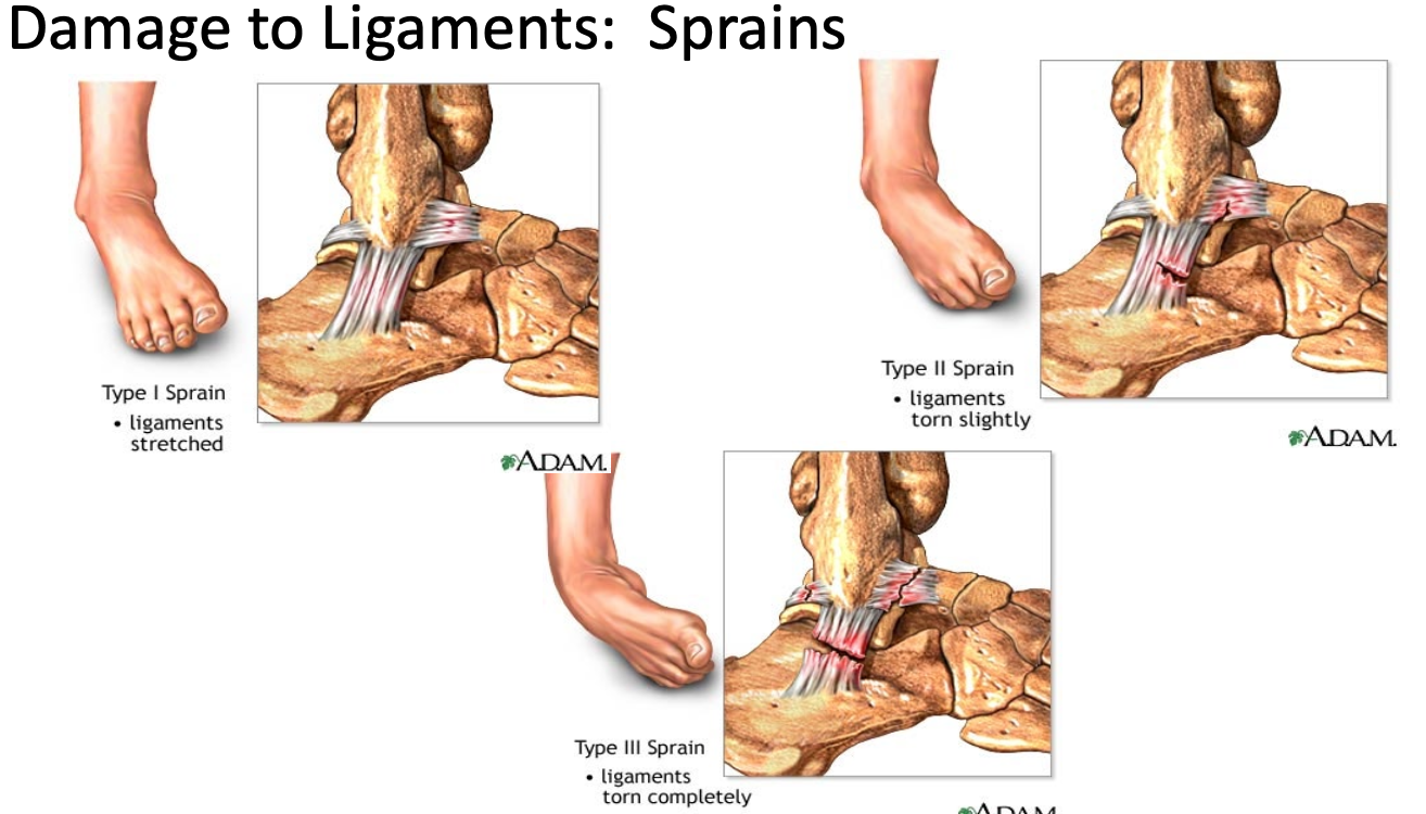 <p>Hard to put ligament together</p>
