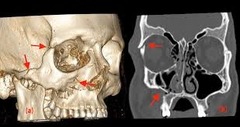 <p>- separation of the fronotzygomatic suture </p><p>- fx of the orbital floor</p><p>- fx of the lateral wall of the ipsilateral maxillary sinus</p>