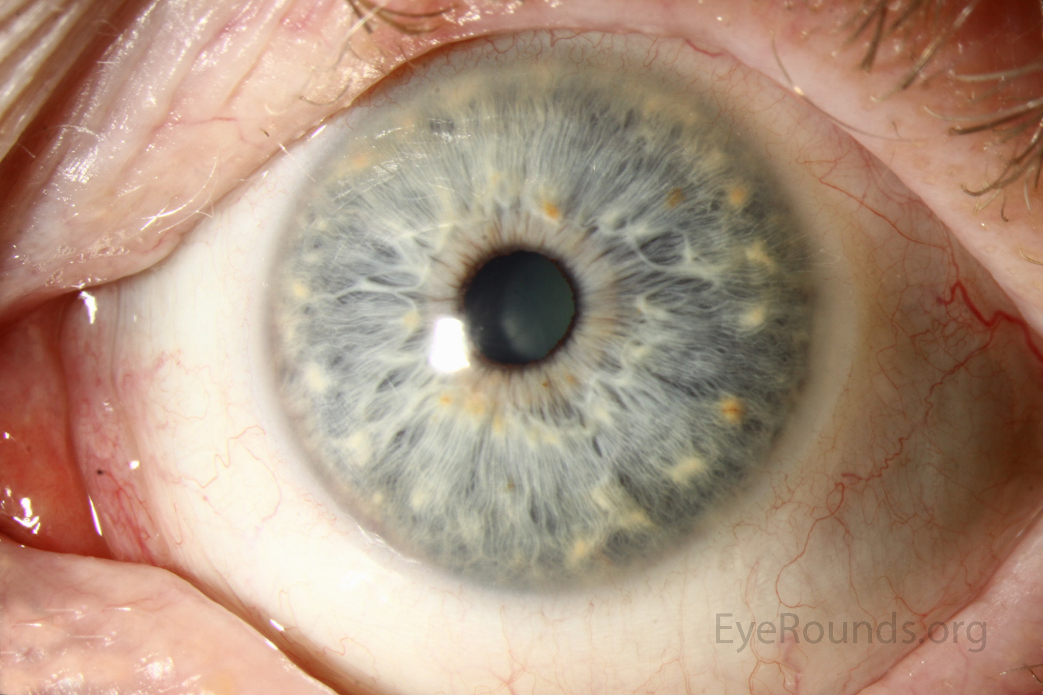 <p><span>tiny, white, gray, brown, or yellowish specks that appear along the outer edge of the iris,</span></p>