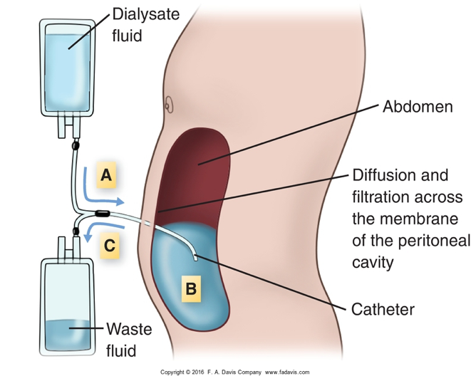 <ul><li><p>wastes and fluids are removed from the blood inside the body, across peritoneal membrane </p></li><li><p>a dialysate solution is intermittently introduced into and removed from the peritoneal cavity through a catheter </p></li><li><p>uses: diffusion, filtration, osmosis </p></li></ul><p></p>