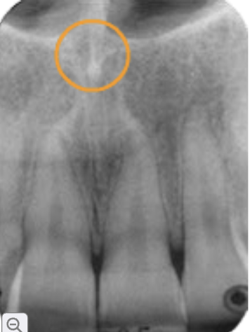 <p>anterior nasal spine</p>