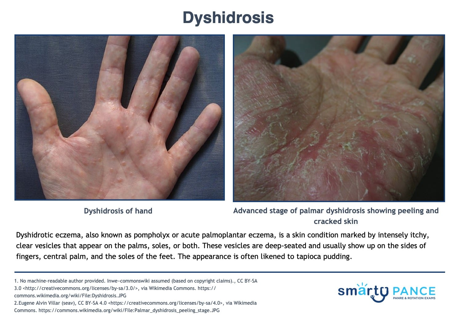 <p>Itchy vesicular eruption of clear, deep-seated vesicles without surrounding erythema on the lateral fingers, palms, and soles</p><p>-Described as “tapioca pudding” triggered by stress, sweating, contact allergens </p><p>-Dx: clinical</p><p>-Tx: high potency topical corticosteroids </p>