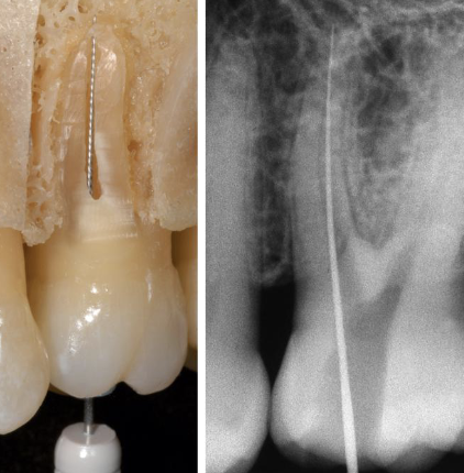 <p>Apical patency is technique where </p>