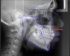 <p>which anatomical landmark:</p><p>- Deepest point of the curve of the maxilla, between anterior nasal spine (ANS) and the dental alveolus</p>