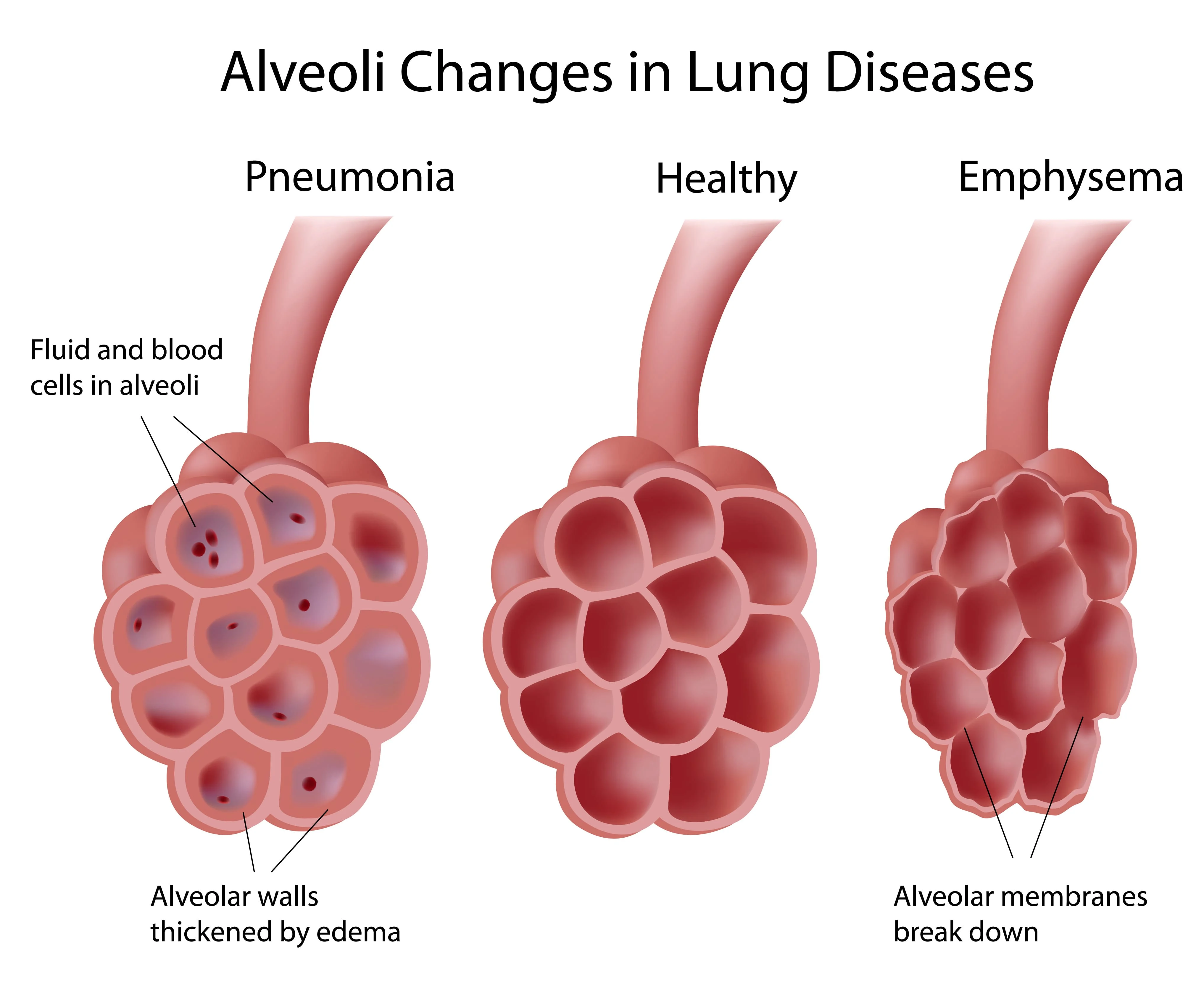 <p>A lung disease in which the air sacs (alveoli) are damaged, making it difficult to breathe.</p>