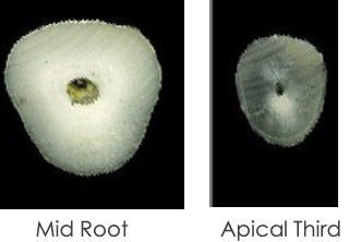 <p>What is the canal shape of a maxillary <strong>central</strong> incisor?</p>