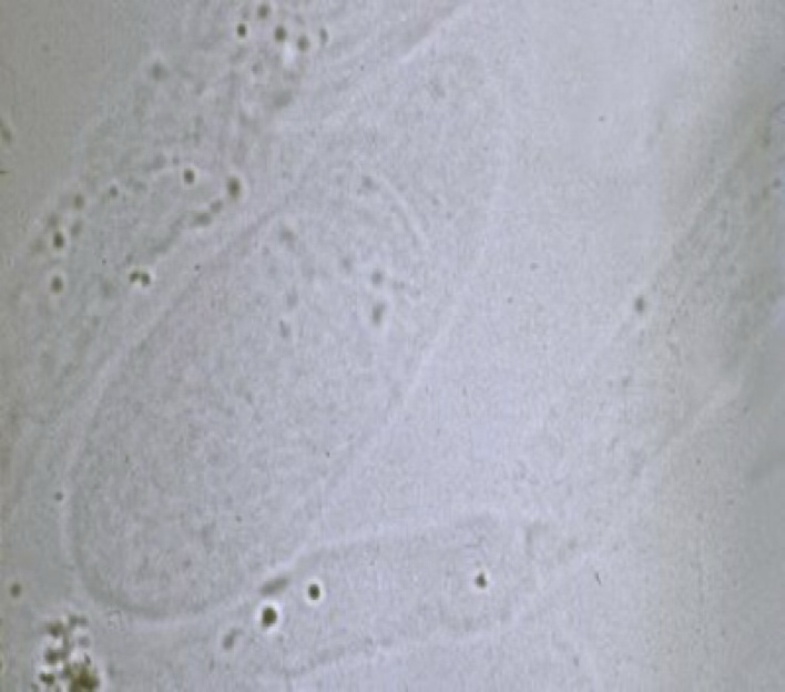 <ul><li><p>Clear, colorless and somewhat transparent.</p></li><li><p>A few seem is normal in urine sediment.</p></li><li><p><strong>An increased number seen can indicate the mildest form of renal irritation,</strong> as well as fever, poor renal perfusion, strenuous exercise or general anesthesia.</p></li></ul><p></p>