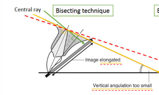 <p>What vertical angulation error results in vertical angle being too small (under-angulation)</p>