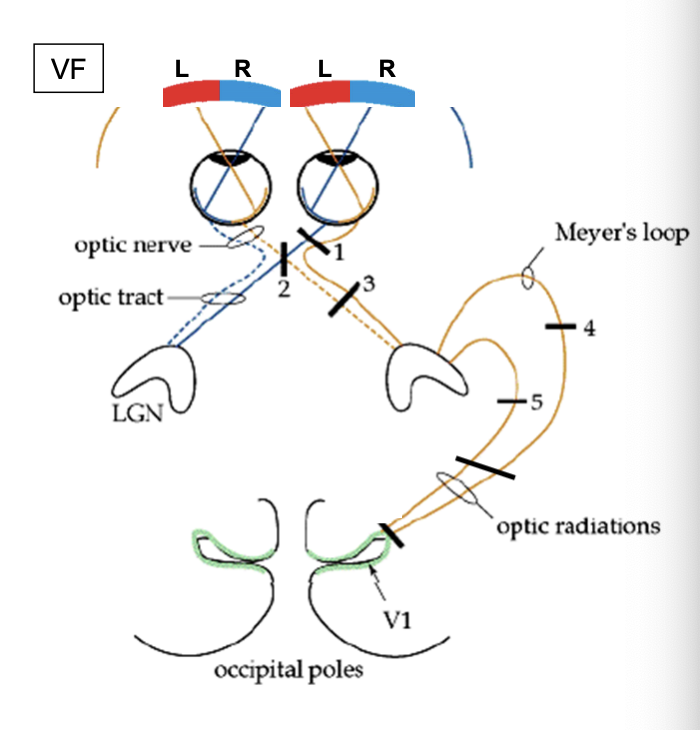 <ol><li><p>R. Optic nerve</p></li><li><p>optic chiasm </p></li><li><p>R. Optic tract </p></li><li><p>R. Meyer’s loop (lower optic radiations) </p></li><li><p>R. upper optic radiations </p></li><li><p>R. optic radiations </p></li></ol><p></p>