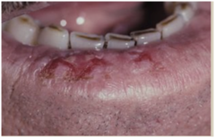 <p>Premalignant lesion on lower lip vermilion</p><p>Chronic UV light exposure</p><p>Esp. older males</p><p>(Analogous to actinic keratosis of skin)</p>