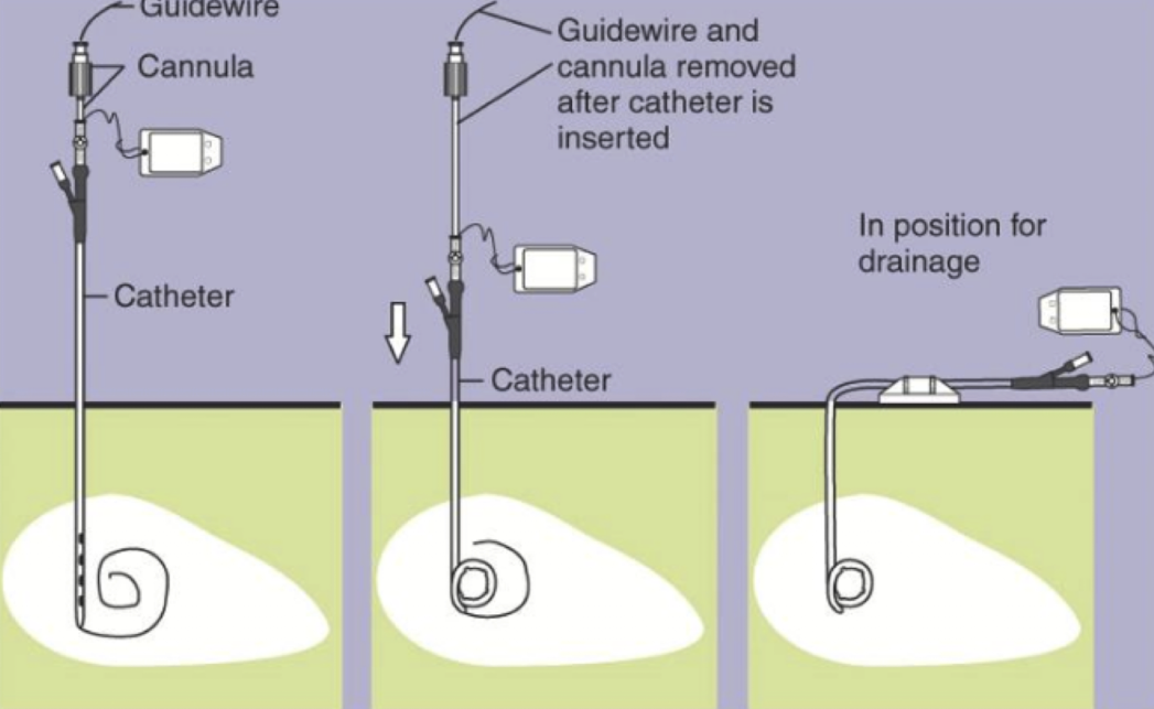 <p>percutaneous biliary drainage</p>