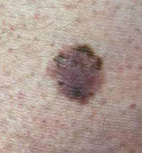 <p>with nevi (moles), when are you suspicious?*</p>