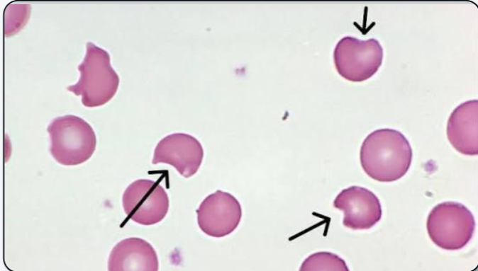 <p>What abnormal RBC shape is indicated? Why is part of the cell missing?</p>