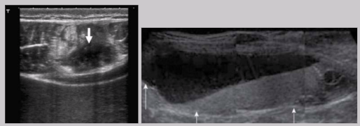 <ul><li><p><span style="background-color: transparent;">Collection of blood in tissue&nbsp;</span></p></li><li><p><span style="background-color: transparent;">Indication: trauma, pain, palp mass, ecchymosis, <u>decreasing hematocrit</u></span></p></li><li><p><span style="background-color: transparent;">Can be uni or bilateral</span></p></li><li><p><span style="background-color: transparent;">US appearance:</span></p><ul><li><p><span style="background-color: transparent;">Heterogeneous&nbsp;</span></p></li><li><p><span style="background-color: transparent;">Hypoechoic to hyperechoic</span></p></li><li><p><span style="background-color: transparent;">Fluid-fluid levels</span></p><ul><li><p><span style="background-color: transparent;">Fluid can contain echogenic debris</span></p></li></ul></li></ul></li><li><p>Blood work is used to differentiate between hematomas and abscesses</p></li></ul><p></p>