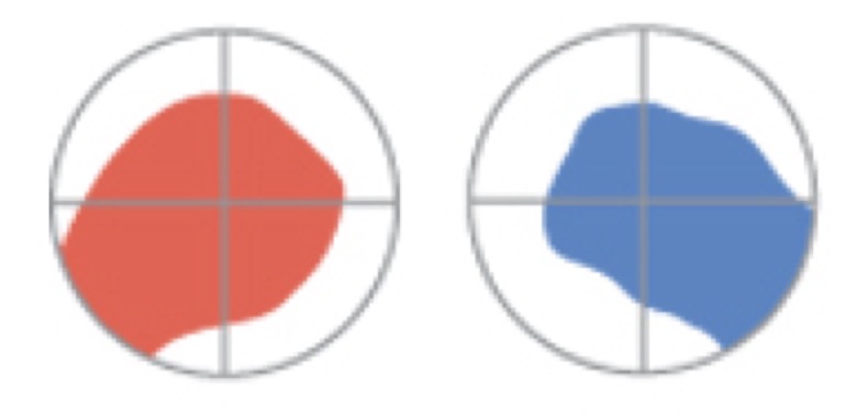 <p>monocular blindness </p>