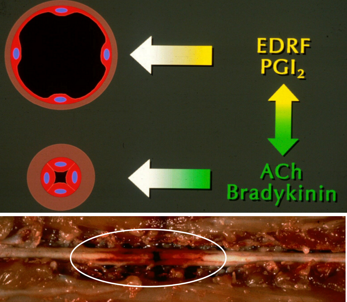 <p>1: this is mediated by factors released by endo cells like endo relaxation factor (EDRF) &amp; prostacyclin → AKA this is an <strong>active process</strong>, BV’s aren’t just naturally open, they need signals to keep them from collapsing</p><p>.</p><p>2: constrict to stop the bleeding</p><p>.</p><p>3: during hemorrhage, oxyhemoglobin &amp; acute phase proteins like bradykinin are secreted → they trigger free radicals to accum → radicals damage endo cells → less EDRF is made → arteries constric…</p><p>if this signaling is prolonged (constriction continues several days after initial injury), constriction becomes EXCESSIVE (AKA delayed onset arteriospasm) → ischemia</p><p>.</p><p>4: the myelomalacia (pannecrosis of SC) can easily ascend &amp; descend thru the SC bc fluid easily flows thru WM (compared to GM) &amp; in the SC, the WM is adjacent to subarachnoid space (where hemorrhage comes from)… as this progresses, pt loses neuro fn until eventually it can’t breath &amp; dies</p><ul><li><p>grossly: see pic, the circle shows necrosis &amp; hemorrhage extending cran &amp; cd</p></li></ul><ul><li><p><em>reminder: SC anatomy is reverse of brain, WM on outside, GM on inside</em></p></li></ul><p>.</p><p>key point: keep an eye on these pt’s!! they may initially look fine, but can progress to this a few days later!</p>