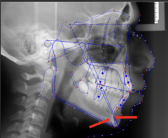 <p>which anatomical landmark:</p><p>- The internal and external aspects of the symphysial border</p><p>- Used to superimpose the mandible</p>