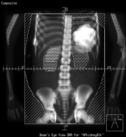 <p></p><p><span>The treatment field shown is likely for the management of:</span><br></p><p>A ovarian cancer</p><p>B Hodgkin's disease</p><p>C seminoma</p><p>D Wilm's tumor</p>