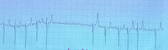 <p>This picture shows which arrhythmia?</p>