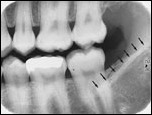 <p>Radiopaque line above mandibular molars</p>