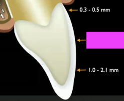 <p>How much enamel do you have in the middle 1/3 of the tooth?</p>