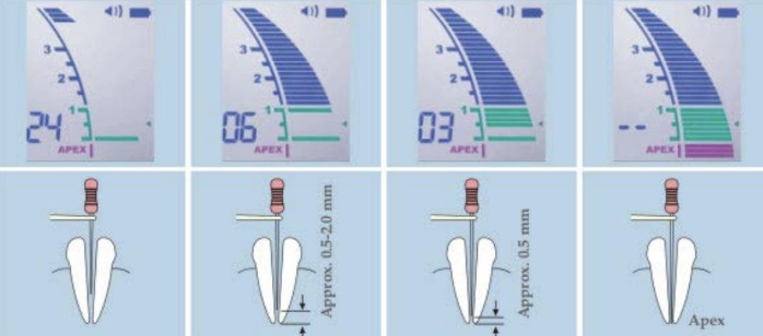 <p>To determine working length, this helps clinically along with radiographic WL</p>