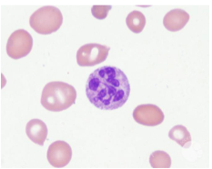 <ul><li><p>≥5 lobes of nuclei in neutrophils</p></li><li><p>Condition: megaloblastic anemia (B12 deficiency)</p></li></ul><p></p>