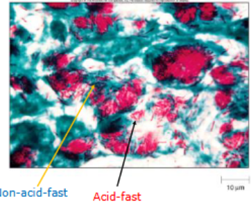 <p>requires multiple steps </p><ul><li><p>Primary dye (carbol fuchsin)</p><ul><li><p>colors all bacteria red</p></li></ul></li><li><p>decolorizer (acid alcohol)</p><ul><li><p>removes red stains from non acid-fast bacteria </p></li></ul></li><li><p>counter stain (methylene blue)</p><ul><li><p>colors non acid-fast bacteria blue, so acid fast is red </p></li></ul></li></ul><p></p>