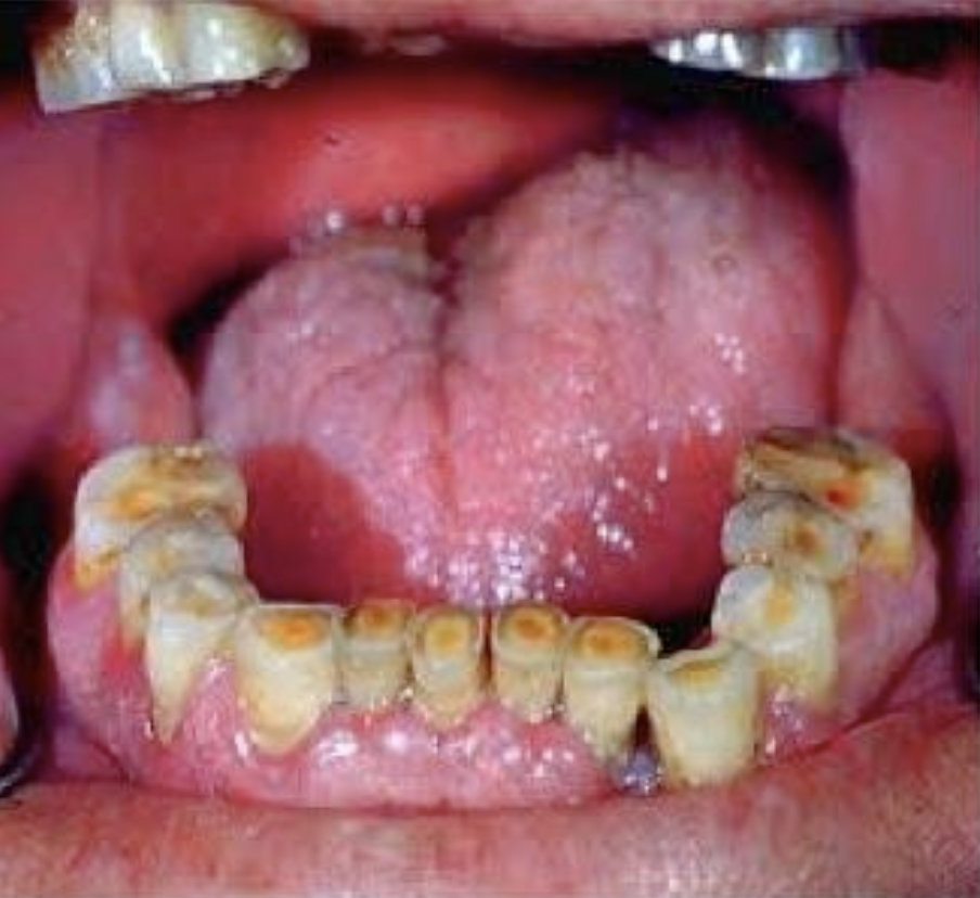 <p>Which of the following is shown in the photo?</p><p>A. Attrition </p><p>B. Erosion </p><p>C. Abfraction </p><p>D. Abrasion Attachment</p>