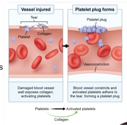 <p>Accumulation of aggregated platelets that initially plug the tear </p>