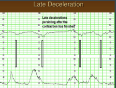 <p>- Greater 30 seconds to reach Nadir.</p><p>- Nadir after uterine contractions peak.</p>