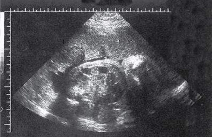 <p>Normal to see small amount of anechoic fluid within small bowel and brighter areas in meconium; collapsed fetal colon typically appears hypoechoic relative to adjacent structures</p>