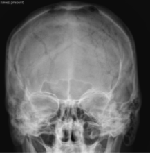 <p>PA skull</p>