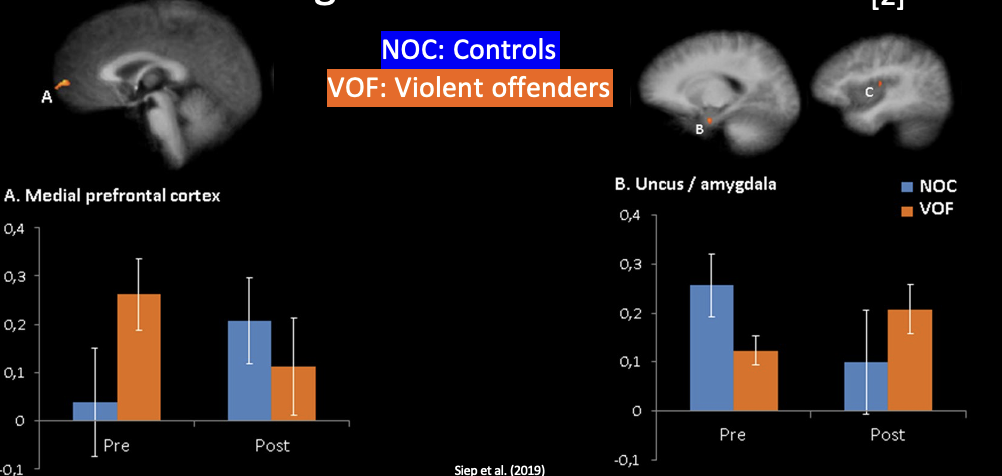 <p>Siep et al (2019)</p><p>Violent offenders show poor emotion regulation due to abnormal PFC–amygdala interaction</p><p></p><p>Study setup:</p><ul><li><p>25 violent offenders (high reactive aggression)</p></li><li><p>24 controls</p></li><li><p>Emotions induced using stories (anger, happy, neutral)</p></li></ul><p></p><p>Medial PFC (control/regulation):</p><ul><li><p>Controls:</p><ul><li><p>Before → low activity</p></li><li><p>After emotion → increased activity<br>→ PFC engages to regulate emotion</p></li></ul></li><li><p>Violent offenders:</p><ul><li><p>Before → already high (baseline overactive)</p></li><li><p>After emotion → activity decreases<br>→ fails to regulate, becomes dysregulated</p></li></ul></li></ul><p></p><p>Amygdala (emotional reactivity):</p><ul><li><p>Controls:</p><ul><li><p>Before → high activity</p></li><li><p>After emotion → decreases<br>→ PFC successfully downregulates emotion</p></li></ul></li><li><p>Violent offenders:</p><ul><li><p>After emotion → amygdala increases<br>→ Emotion escalates instead of being controlled</p></li></ul></li></ul><p></p><p>Key takeaway:</p><p>Controls:<br>PFC ↑ → Amygdala ↓ → regulated emotion</p><p>Violent offenders:<br>PFC ↓ (when needed) → Amygdala ↑ → loss of control</p>