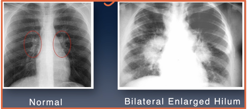 <ul><li><p>Lymph node or tumor inflammation</p></li><li><p>Pulmonary venous or arterial hypertension</p></li></ul><p></p>