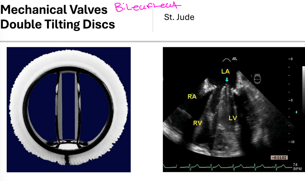 <p>2 pyrolytic carbon semicircular discs</p><p>attached to rigid valve ring by small hinges</p><p>• Opening angle 75-90 degrees</p><p>• 3 orifices - small central and 2 larger</p><p>lateral orifices</p><p>• Normal regurgitant volume 5-10 mL</p>