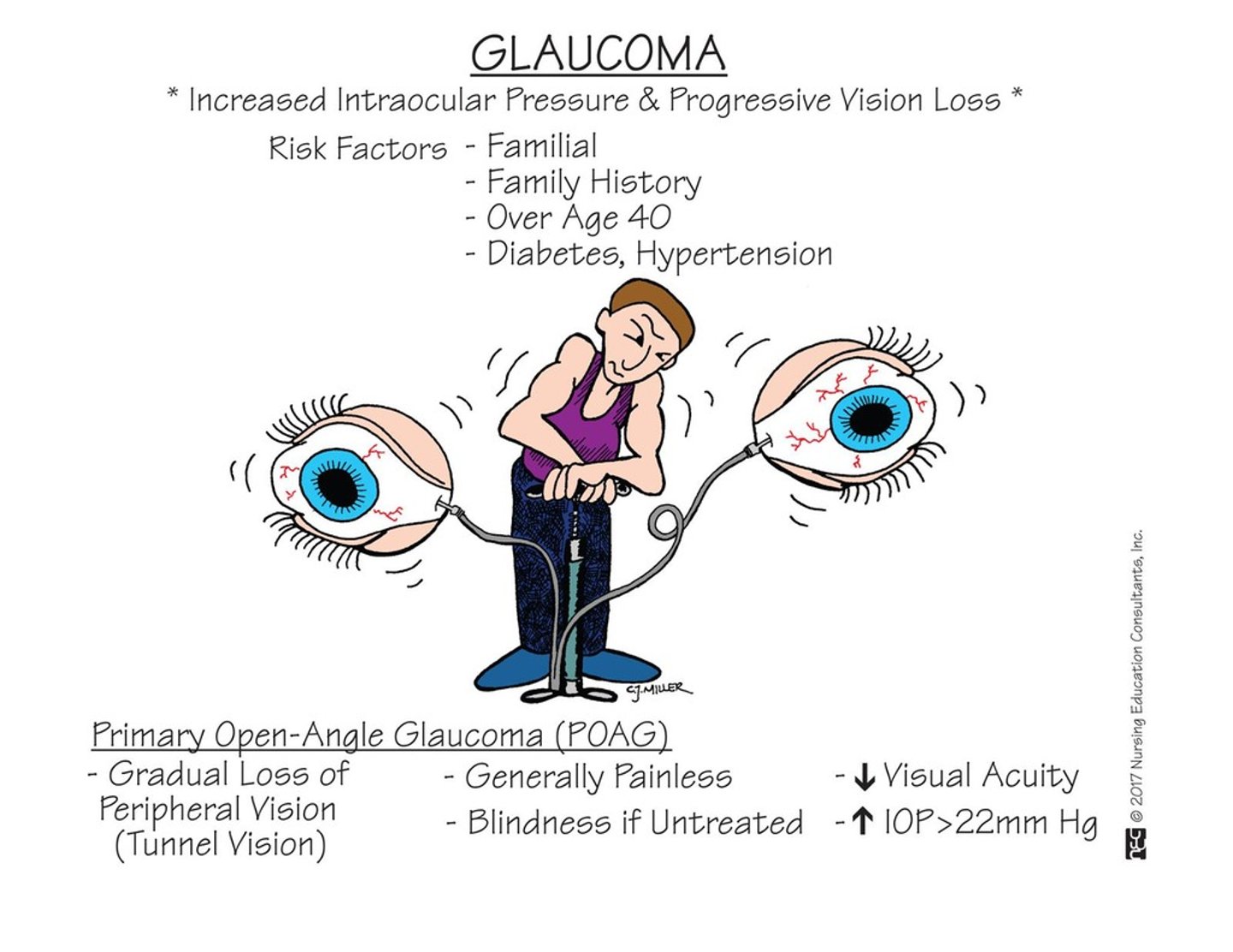 <p>Management of intraocular pressure to prevent vision loss.</p>