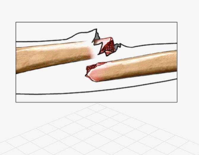 <p>what type of fracture</p>