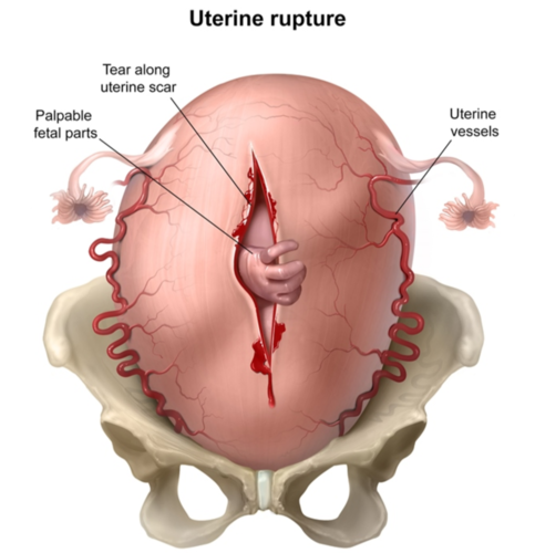 <ol><li><p><span style="color: rgb(236, 81, 81);"><strong>uterine atony</strong> (loss of contractions on palpation)</span></p></li><li><p><span style="color: rgb(169, 123, 30);"><strong>loss of fetal station</strong></span></p></li><li><p>change in <span style="color: rgb(68, 83, 201);"><strong>shape of uterus</strong></span></p></li><li><p>referred <span style="color: rgb(30, 177, 117);"><strong>shoulder/CP</strong></span></p></li><li><p><span style="color: rgb(193, 48, 206);"><strong>abnormal contraction</strong> patterns</span></p></li></ol><p></p><p></p>