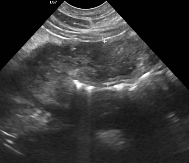 <p>what does the following ultrasound show?</p>