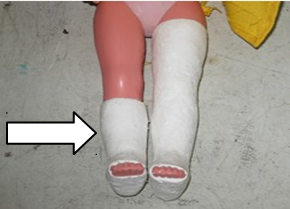 <p>ankles,<span> </span>tarsals<span> </span>and<span> metatarsals</span></p><p><span style="font-family: Calibri, sans-serif;">affection</span></p>