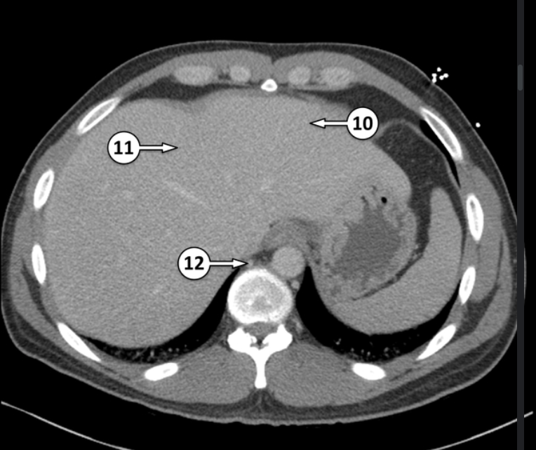 <p>10 and 11 are segments of the liver. Label which segments they are </p>