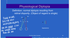 <p>What is the definition of physiological diplopia?</p>