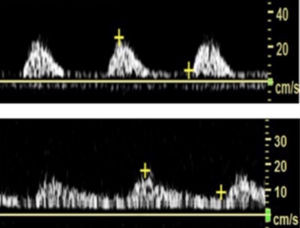 <p>This waveform is seen in distal peripheral artery in lower leg. Its best described as:</p>