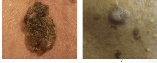 <p>Squamous Cell Carcinoma (SCC)</p><ul><li><p>keratocanthomas are rapidly arising SCC w/ crateriform center w/ smooth, firm border</p></li><li><p>Highest areas of metastasis: lips/ears/scalp</p></li></ul><p>MIMIC: Seborrheic Keratosis (benign skin lesions)</p><ul><li><p> stuck on/flattened ball of wax</p></li></ul><p></p>