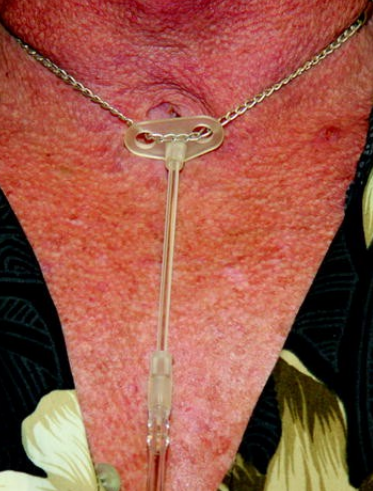 <ul><li><p><span>Used for long-term O2 therapy</span></p></li><li><p><span>Indicated when there are complications with or suboptimal nasal cannula use, nocturnal hypoxemia despite nasal cannula</span></p></li></ul><p></p>